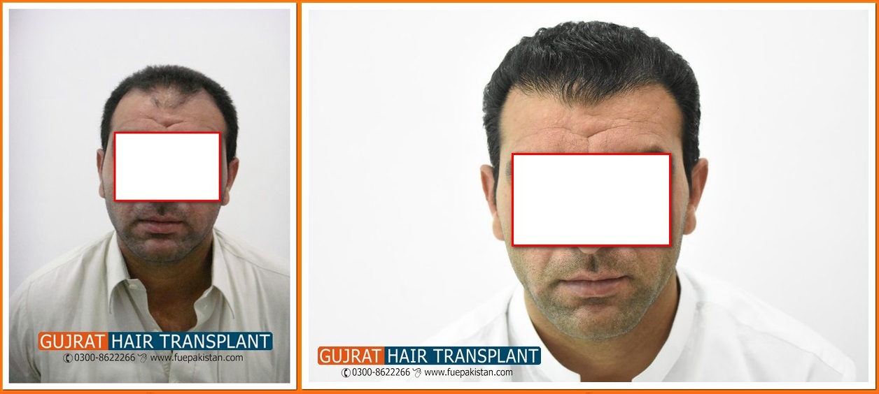 PRP Plus FUE Hair Transplant Surgery Results Before & After - FUE Pakistan  Certified Hair Transplant Surgeon