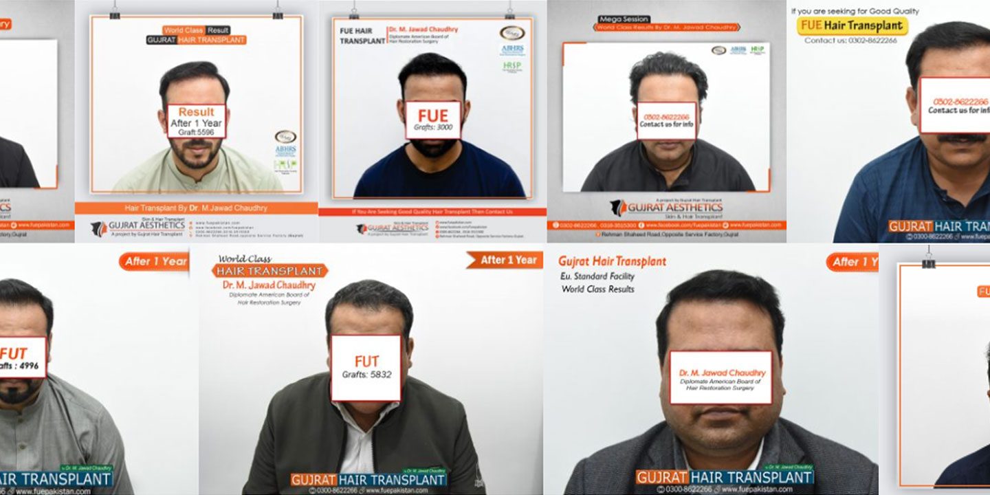 FUE Hair Transplant In Pakistan FUE Hair Transplant In Pakistan