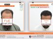 Hair Transplant Pakistan